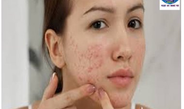 क्या आप मुंहासों से परेशान हैं,  तो आपके लिए है ये आर्टिकल