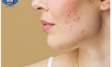 फेस पर  Acne  की वजह बनते हैं ये 4 फूड, आज ही डाइट से निकाल फेंकिए