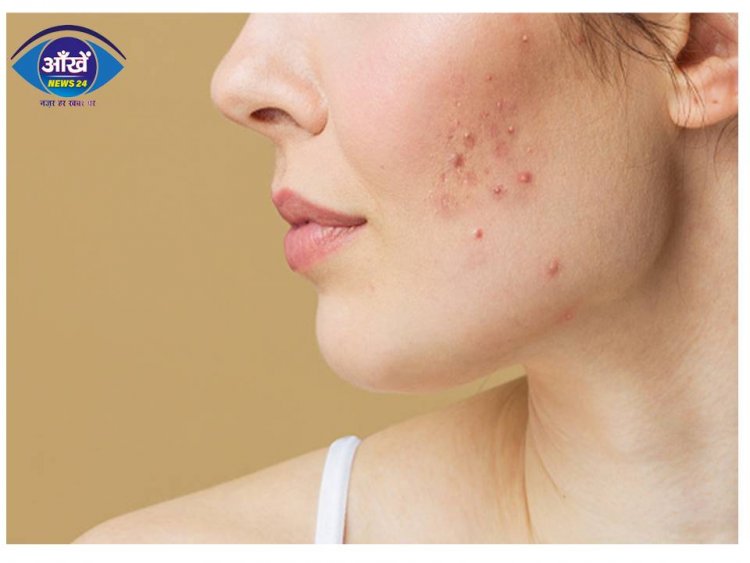 फेस पर  Acne  की वजह बनते हैं ये 4 फूड, आज ही डाइट से निकाल फेंकिए