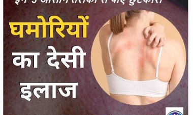 गर्मियों में क्यों निकलती हैं घमोरियां? इन 5 आसान तरीकों से पाएं छुटकारा