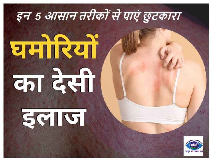 गर्मियों में क्यों निकलती हैं घमोरियां? इन 5 आसान तरीकों से पाएं छुटकारा