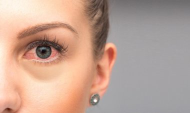 Red Eye: ये है आंख लाल होने की वजह, नजरअंदाज करना पड़ जाएगा भारी