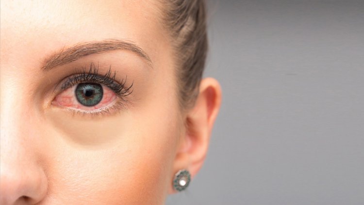 Red Eye: ये है आंख लाल होने की वजह, नजरअंदाज करना पड़ जाएगा भारी
